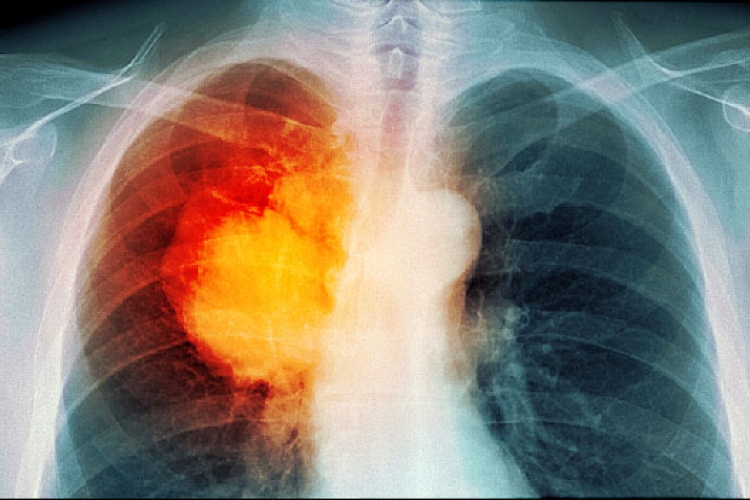 Szlovákiában évente több, mint 2000 ember hal meg tüdőrákban 